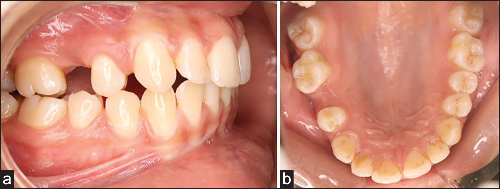 (a) Intra-oral photograph – right lateral. (b) Intra-oral photograph – right lateral maxillary occlusal view