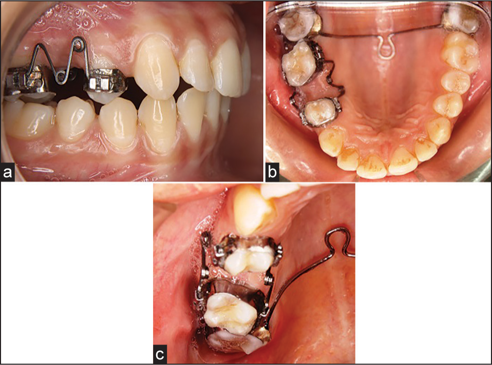 (a) “MK” spring on the day of placement – right lateral. (b) “MK” spring on the day of placement – maxillary occlusal view. (c) “MK” spring on the day of placement – maxillary occlusal view (close up)