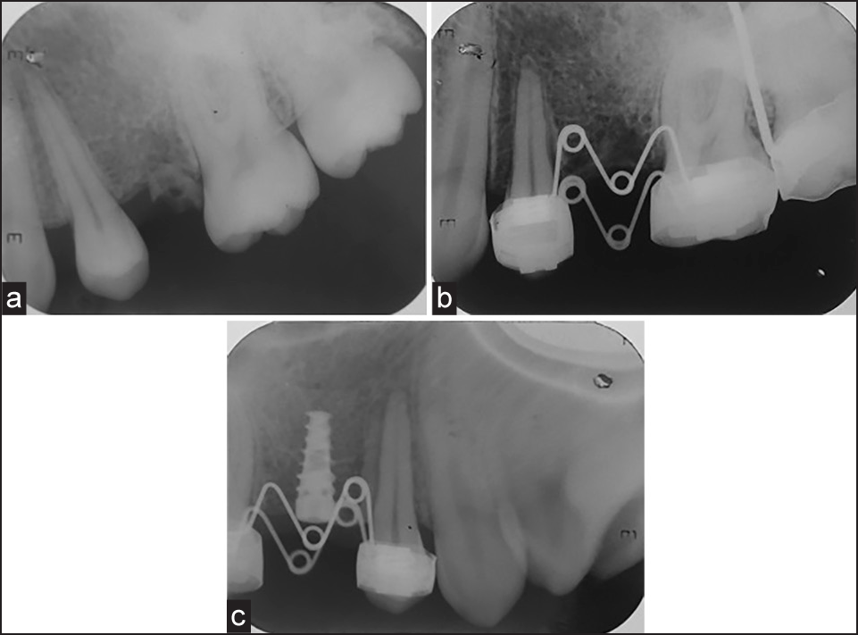 (a) Pretreatment intra-oral periapical. (b) Posttreatment intra-oral periapical. (c) Postimplant placement intra-oral periapical