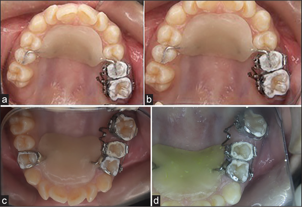 (a) Intra-oral photographs maxillary occlusal view – on the day of appliance placement. (b) Maxillary occlusal view – 1-month later. (c) Maxillary occlusal view - 3 months later