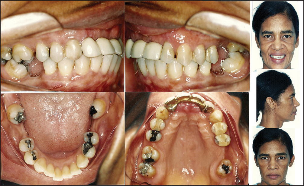 Pretreatment facial and intraoral photographs