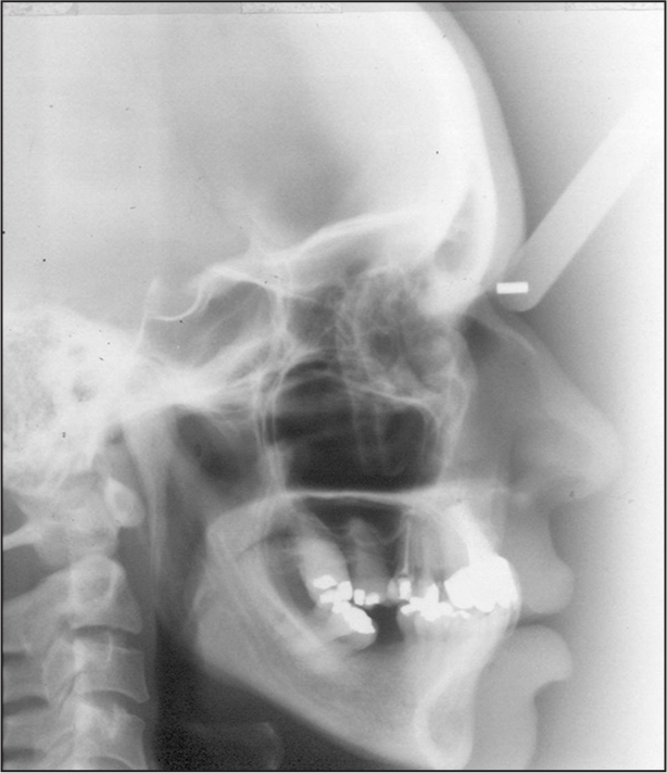 Pretreatment cephalometric radiograph