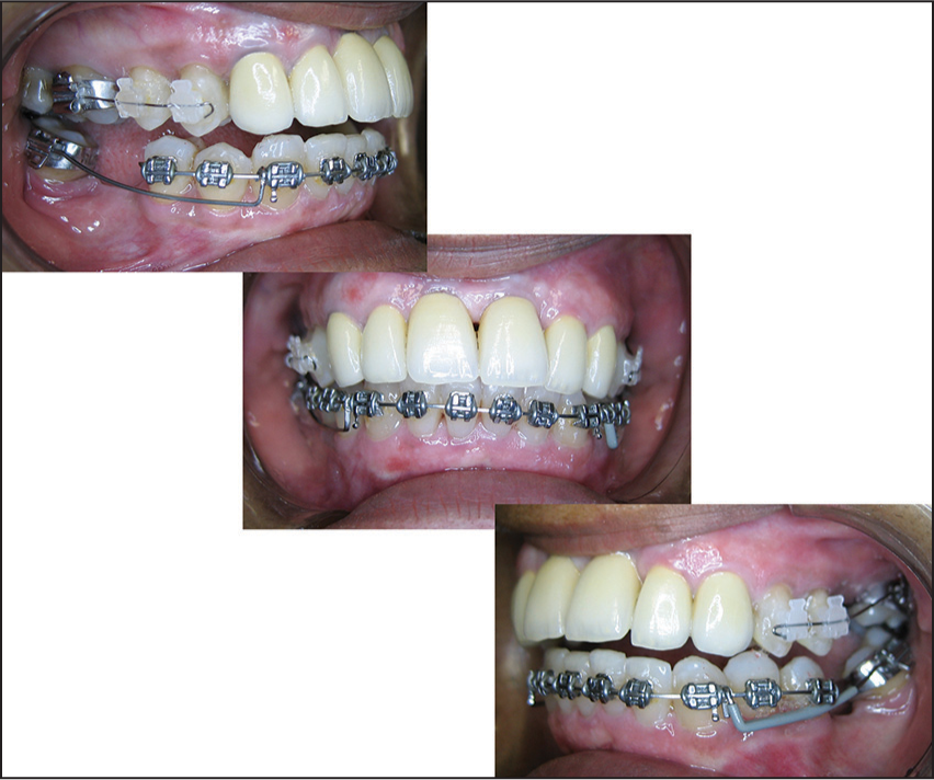 Cantilever of titanium molybdenum alloy to second mandibular molars upright