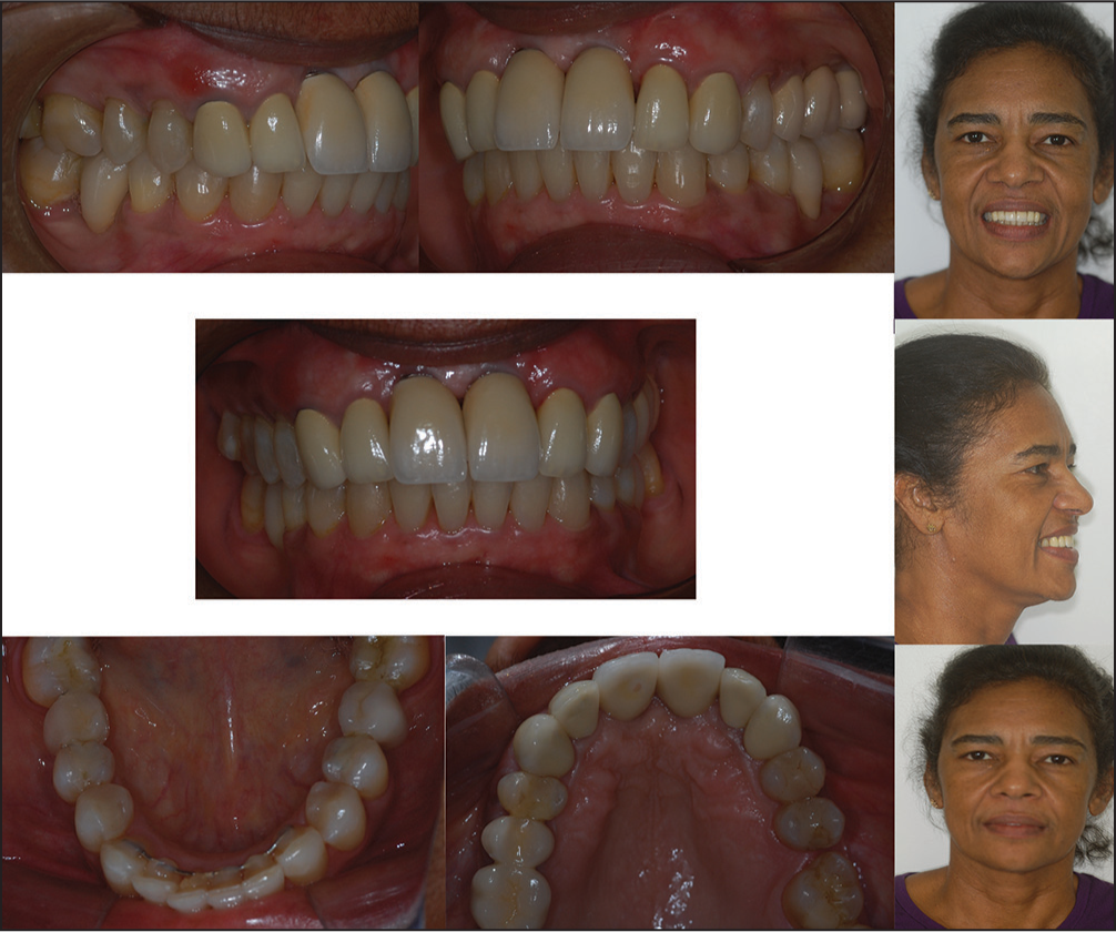 Posttreatment facial and intraoral photographs