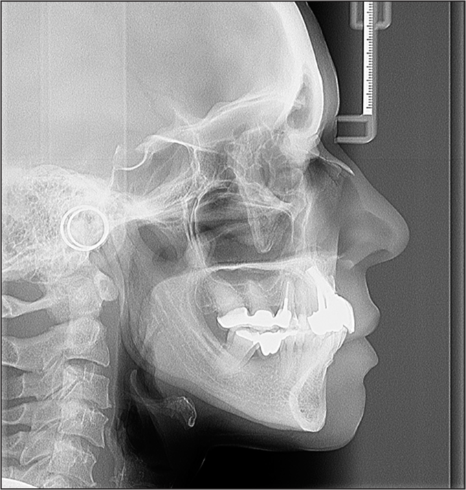 Posttreatment cephalometric radiographs