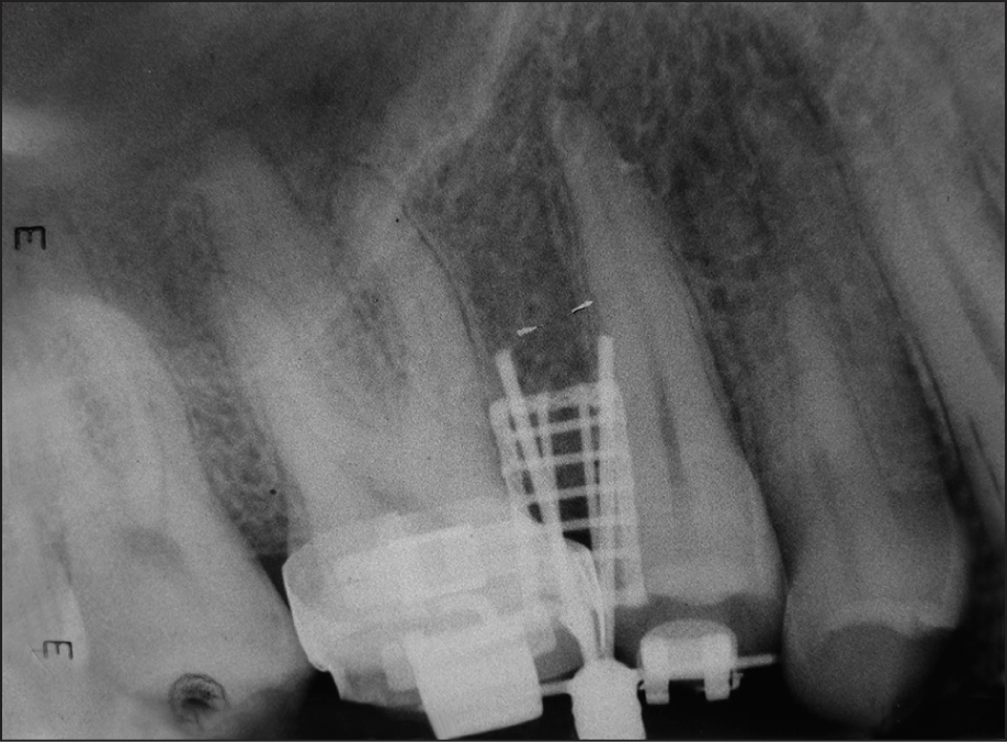 Intra-oral peri-apical radiograph confirms angulation of roots and point of drill