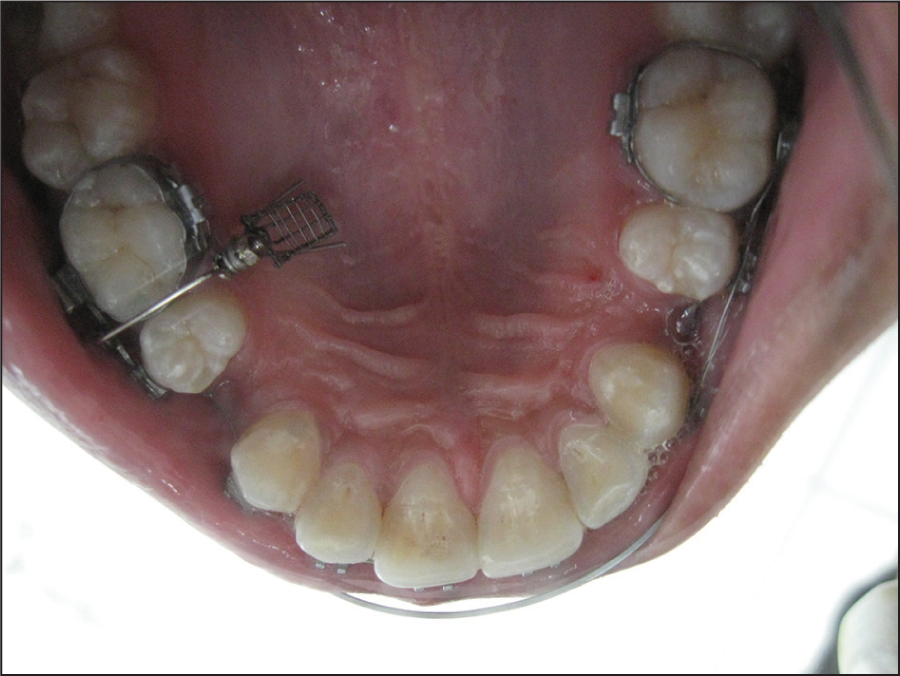 Grid by cross over wire from buccal to palatal
