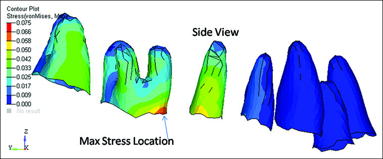 Von Mises stress contours of periodontal ligament