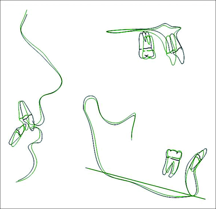 Superimposition of post treatment changes profile, maxilla and mandible. Black pre treatment and Green post treatment