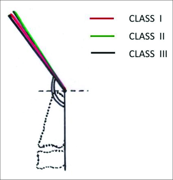 Minimum observed clivo-axial angle for Class I, II, and III were 145°, 146°, and 144°, respectively with standard deviation from normal increasing from Class I to III
