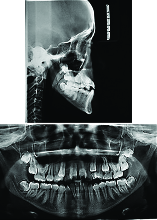 Pretreatment lateral cephalogram and orthopantomogram