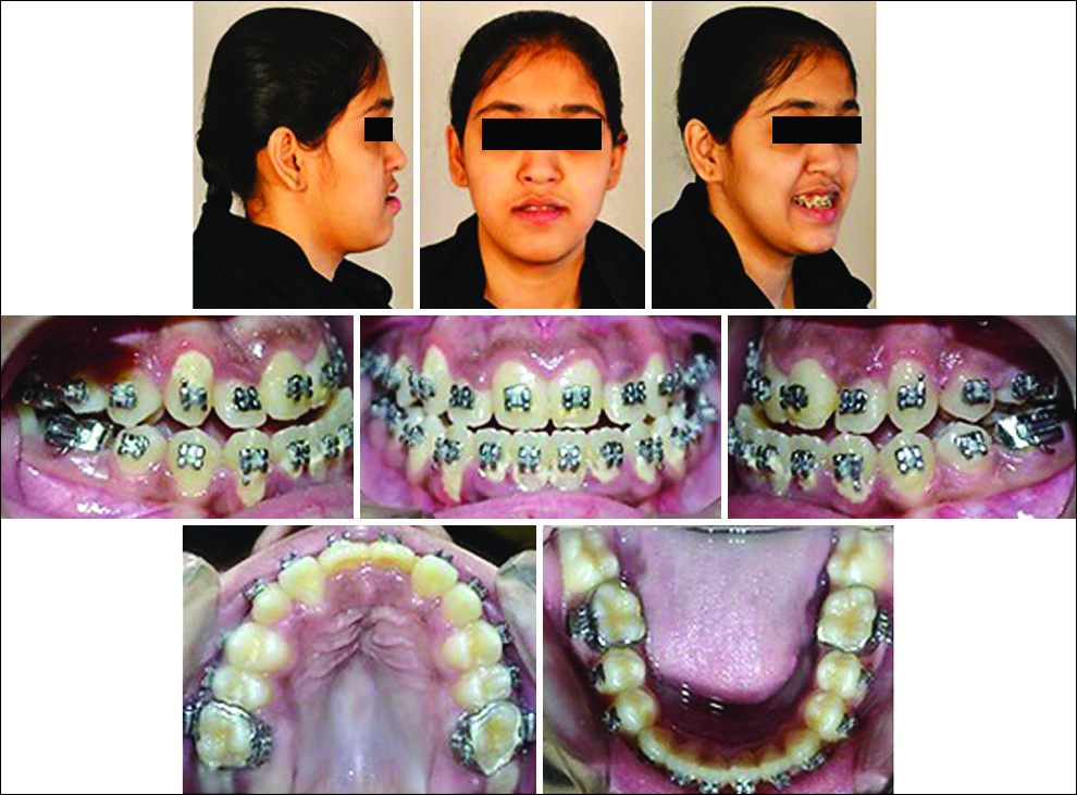 Presurgical photographs - extraoral and intraoral