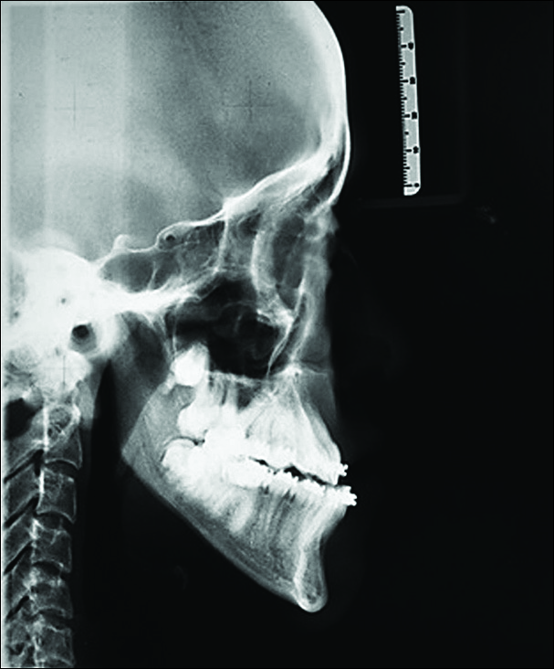 Presurgical lateral cephalogram