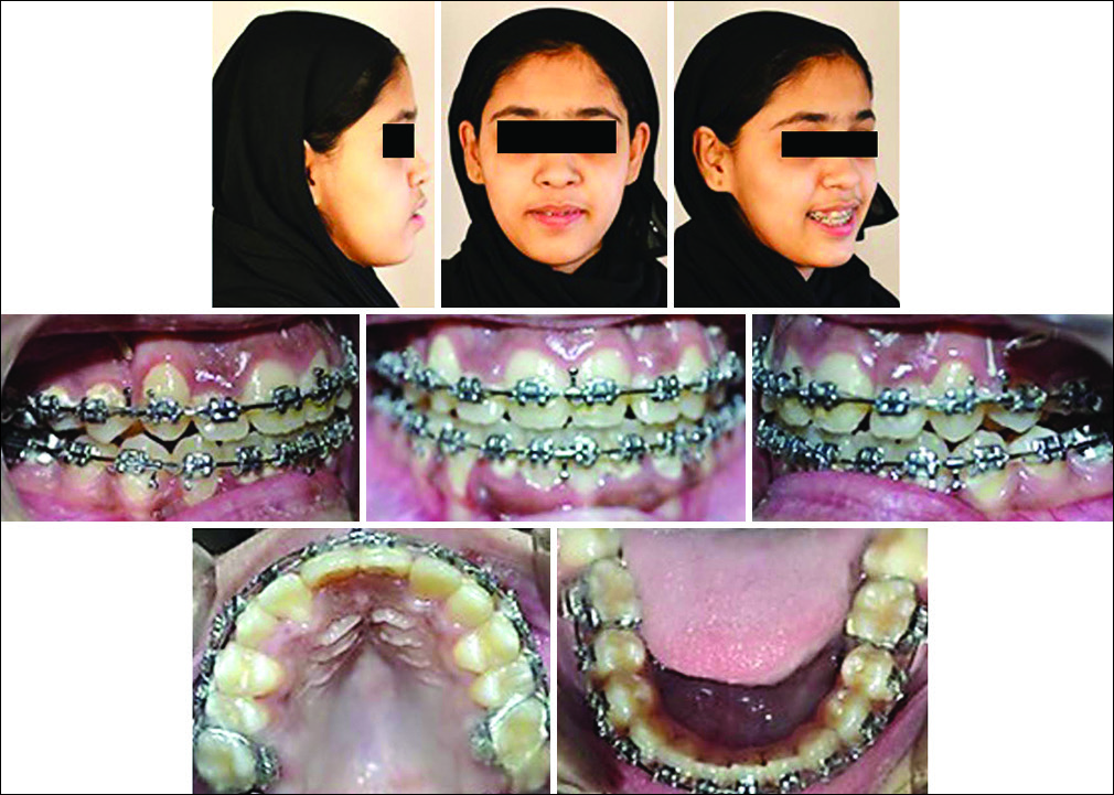 Postsurgical extra- and intra-oral photographs
