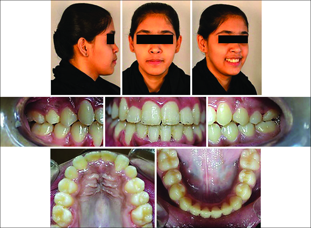 Posttreatment extra- and intra-oral photographs