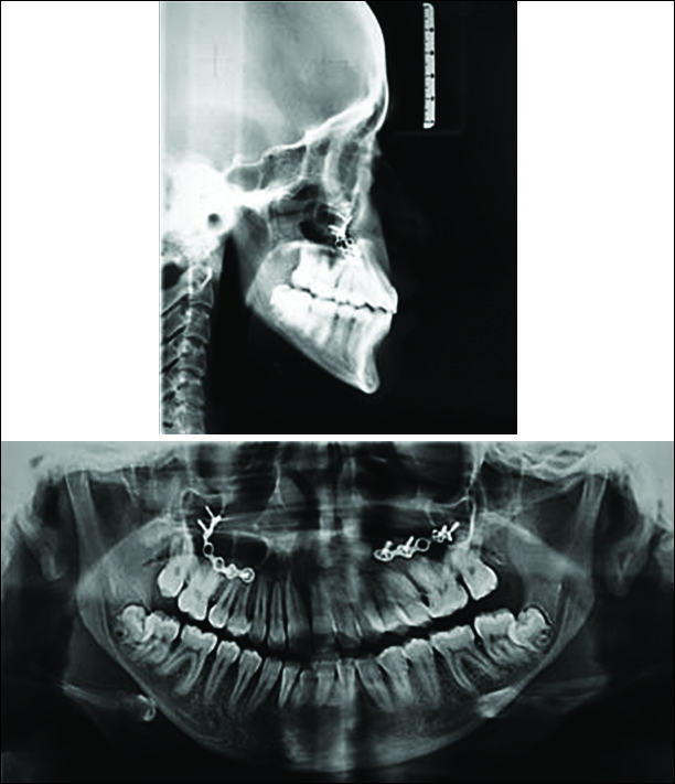 Posttreatment lateral cephalogram and orthopantomogram