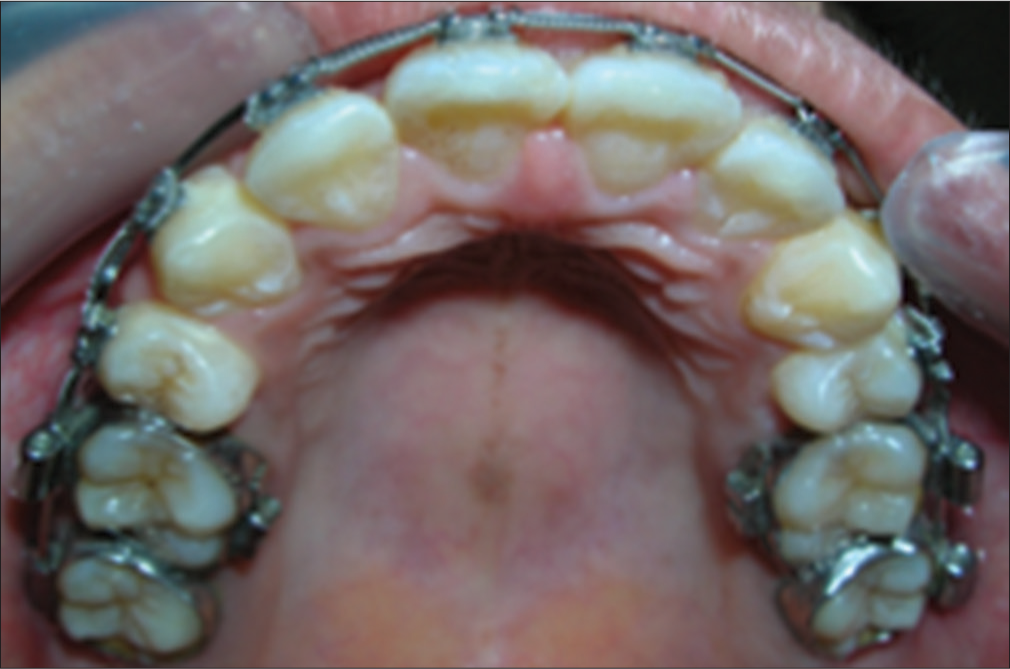 Clinical photographs of orthodontic treatment from pretreatment to