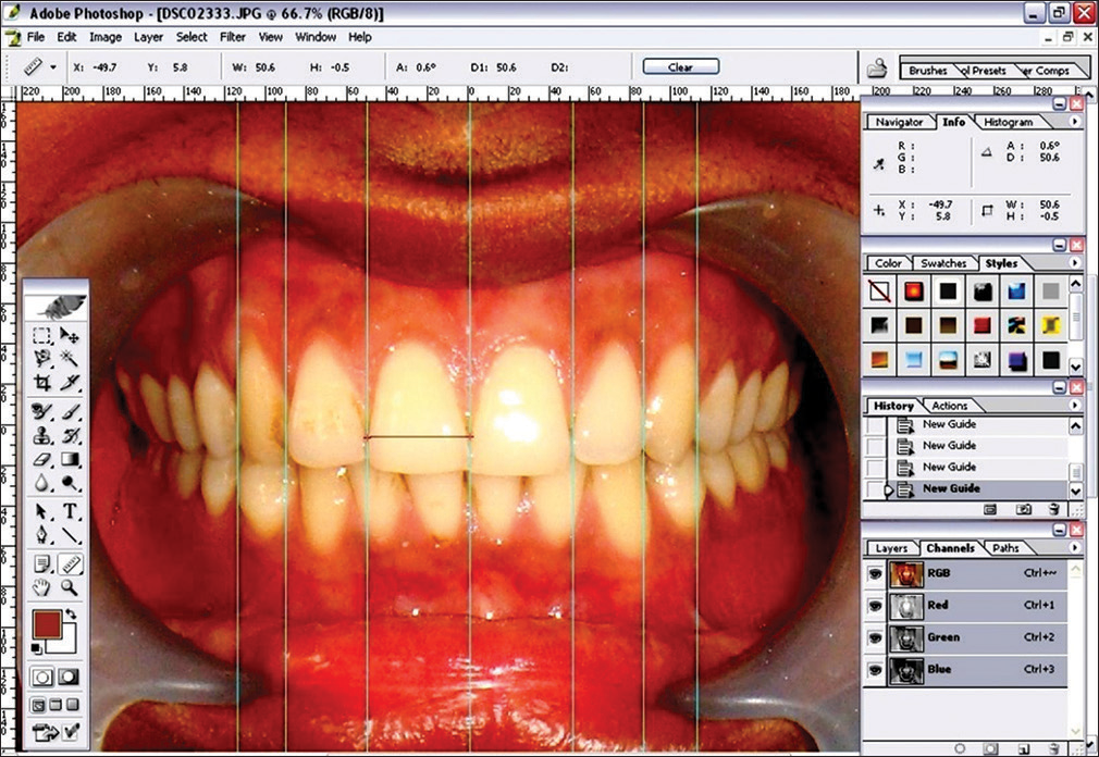 Adobe Photoshop CS version 8.0 software was used to measure the mesiodistal width of maxillary anterior teeth