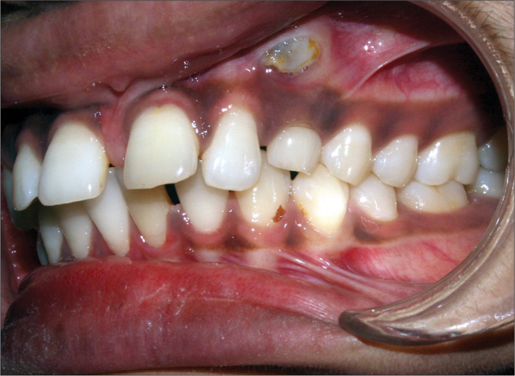 Pretreatment intraoral left lateral photograph