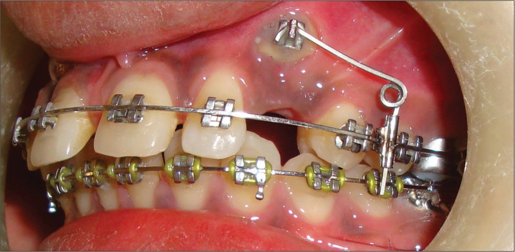 Cantilever spring activation for canine extrusion