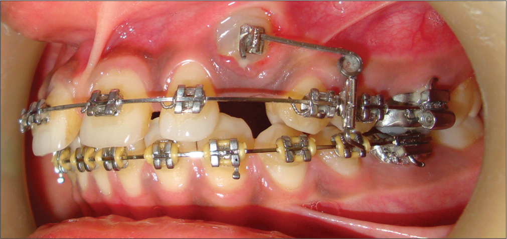 Progress of canine extrusion over 2 months