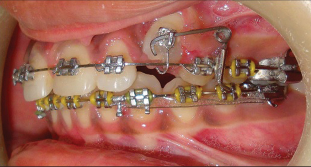 Canine extrusion after 6 months of cantilever mechanics