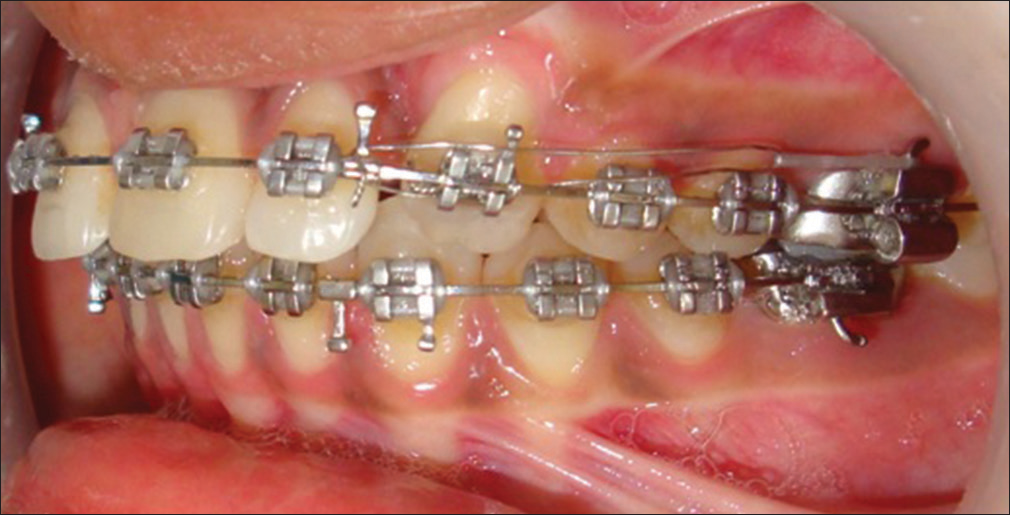 Space closure with stainless steel base archwire after canine alignment