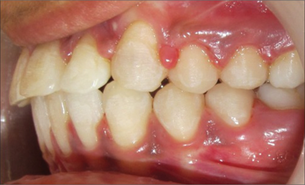 Posttreatment intraoral left lateral photograph