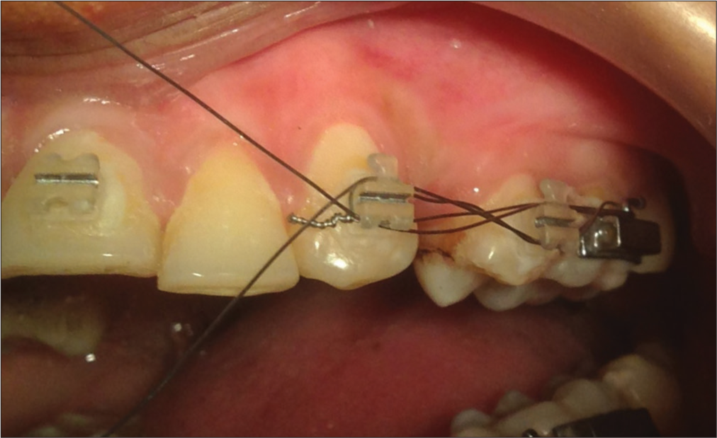 To laceback or not to laceback – that is the question