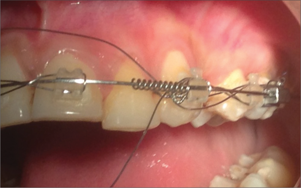 Modified laceback for canine retraction - APOS Trends in Orthodontics