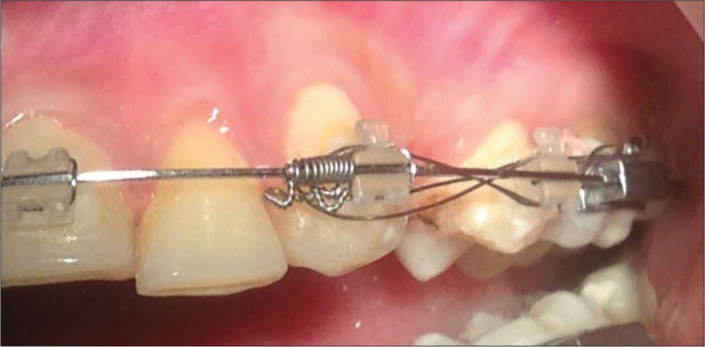 Modified laceback for canine retraction - APOS Trends in Orthodontics