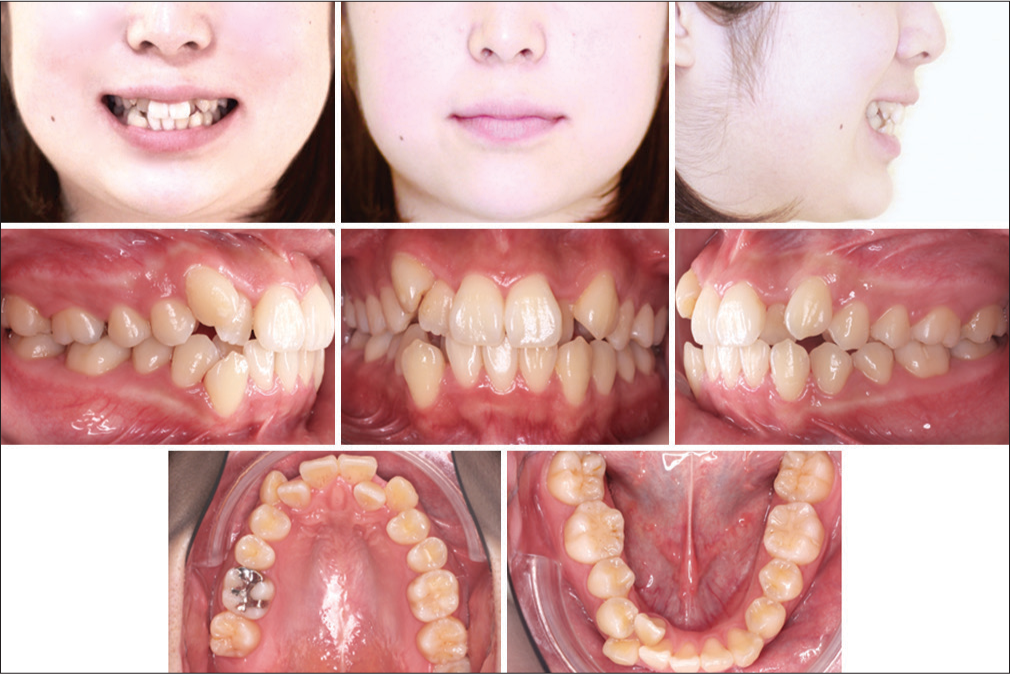 Advanced Aligner Orthodontics - APOS Trends in Orthodontics