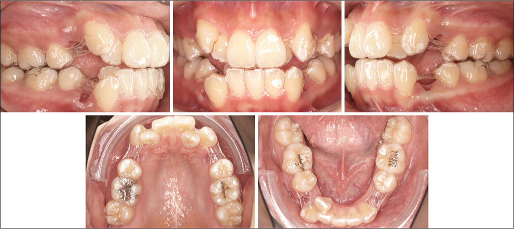 First aligner set post four premolar extraction