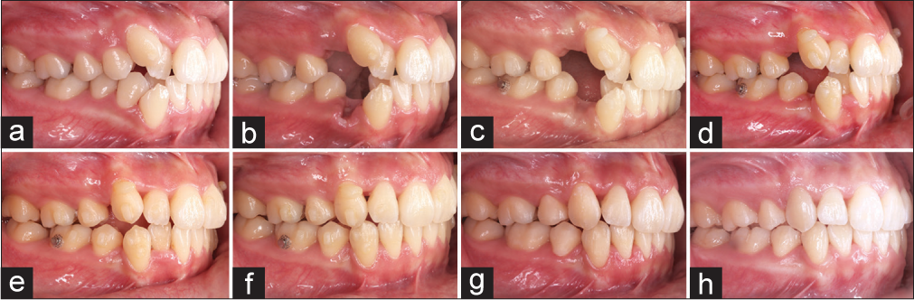 Case 1 treatment procedure (a) Initial (b) Postextraction (c) Attachment (d) Start retraction (e) Anterior retraction (f) Torque (g) Detail (h) Final