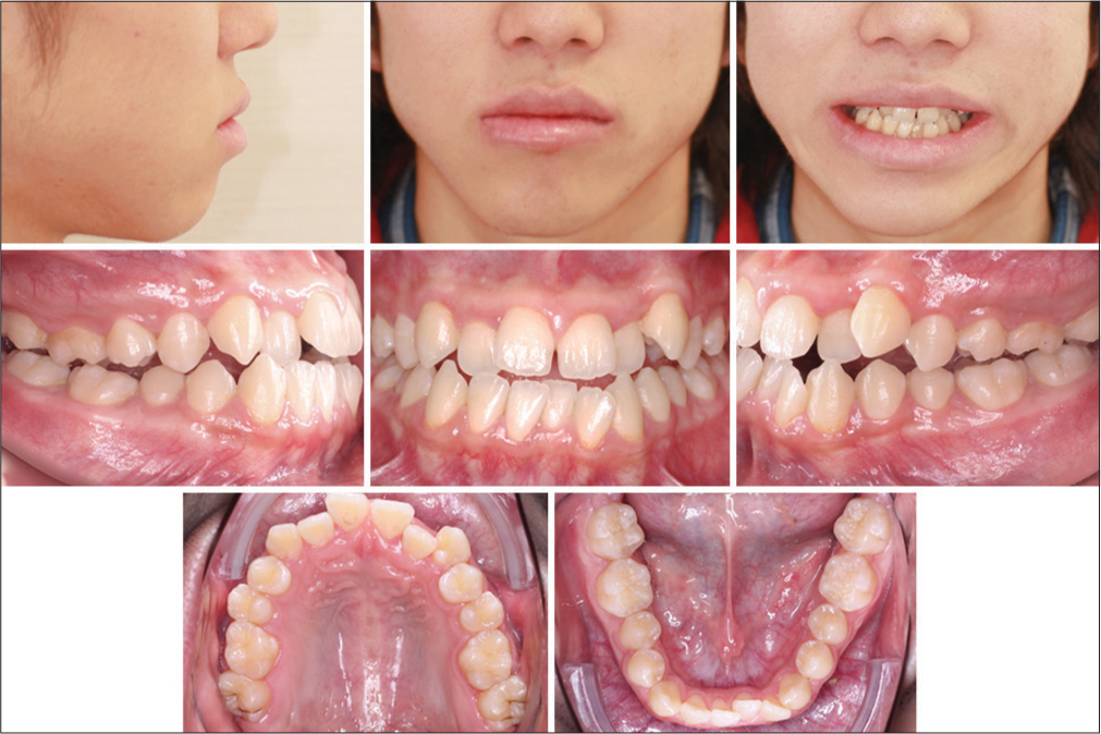 Molar Distalization Hack Using Invisalign First for Class II Correction