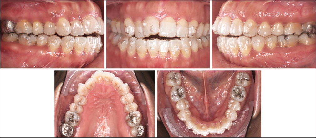 Aligner set with attachment