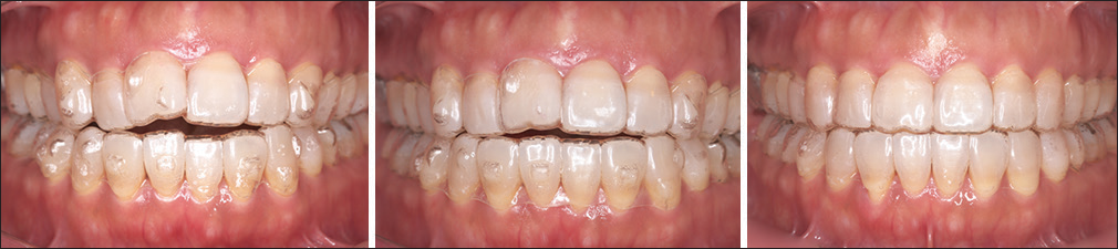 Good Aligner fit during treatment