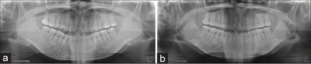 (a) Initial and (b) final orthopantomogram