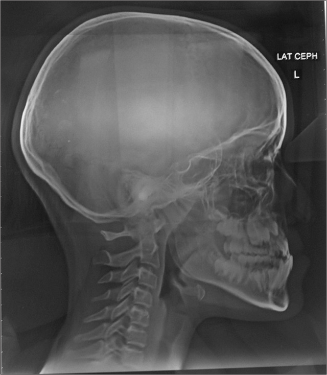 Pretreatment lateral cephalogram