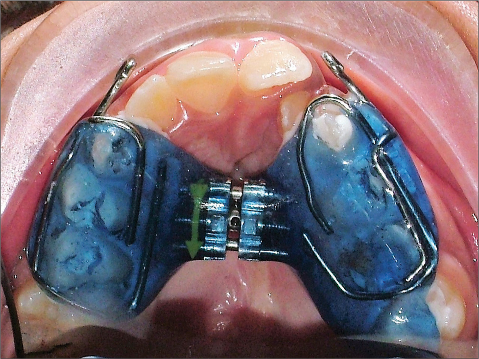 Phase I orthopedic treatment – transverse correction of maxilla with palatal expander