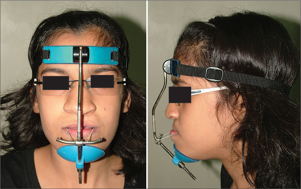 Phase I orthopedic treatment – sagittal correction of maxilla with reverse pull headgear appliance