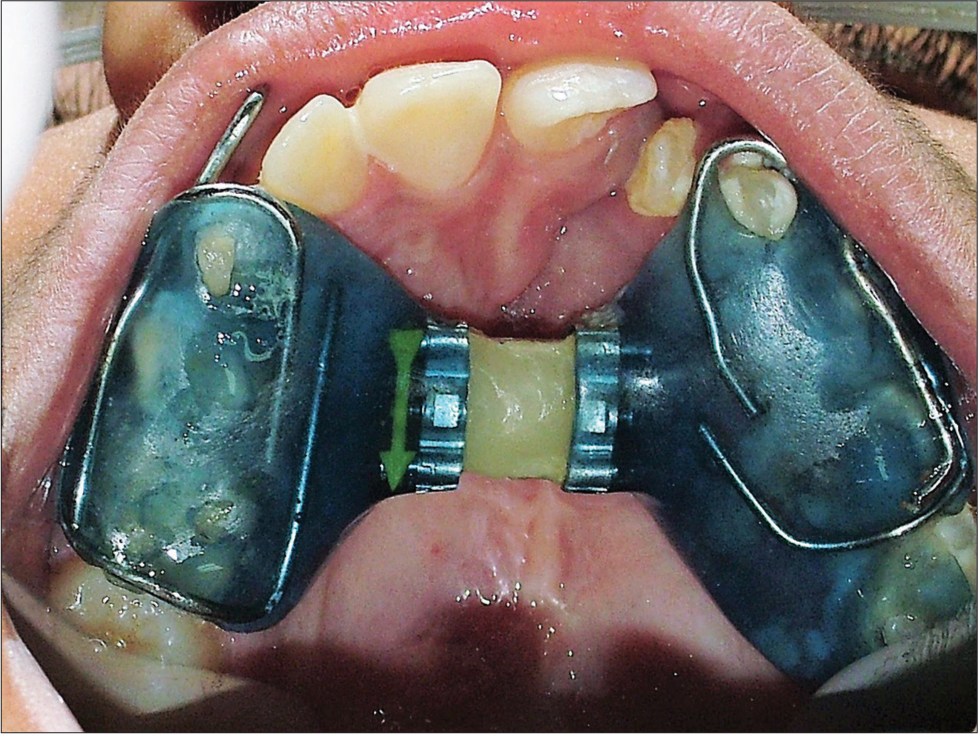 Maxillary occlusal view after palatal expansion. The appliance acts as a retention appliance for 6 months after active expansion is completed. The screw is obliterated with composite to avoid any change