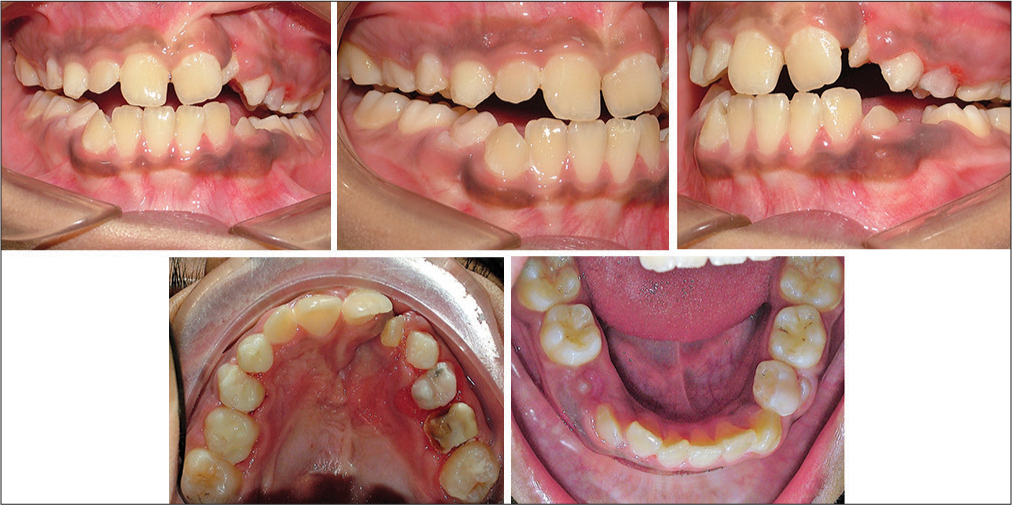 Post Phase I - intraoral photos