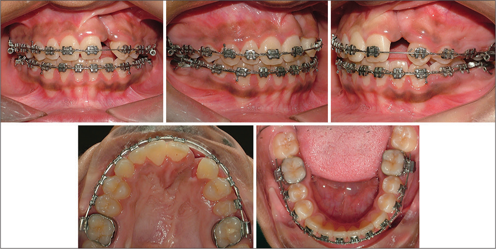 Phase II - fixed appliances, 22 extracted due to poor prognosis, alignment continued