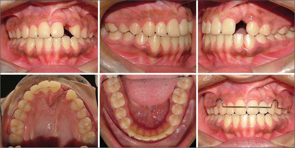 Posttreatment intraoral photos