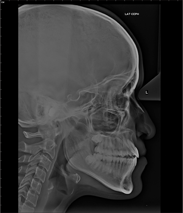 Posttreatment lateral cephalogram