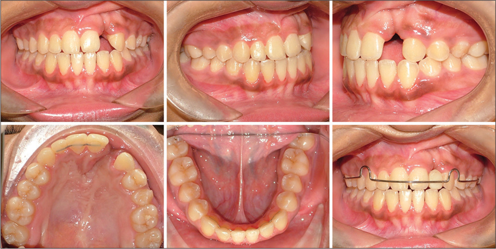 1-year follow-up intraoral photos