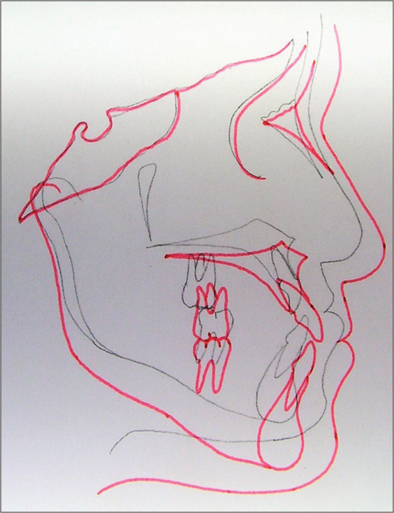 Superimposition showing changes from pretreatment (black) to posttreatment (red)