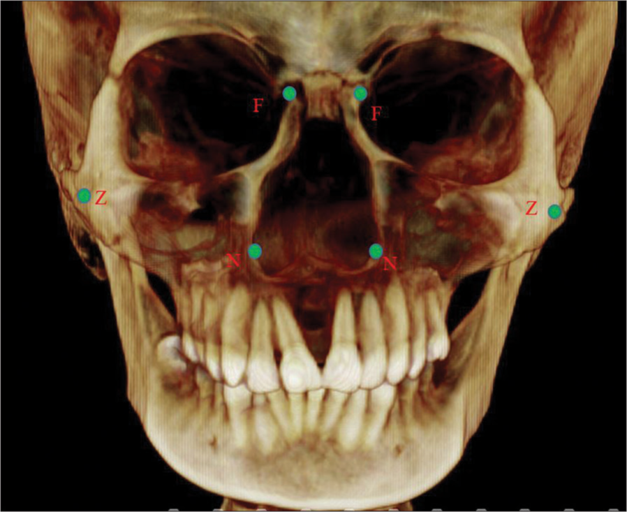 Landmarks for nasal and cranial structures. Cone beam computed tomography at the nasal and cranial level landmarks. N – Lateral most border of nasal cavity; Z – Lateral most border of zygoma; F – Lateral most border at the frontonasal level