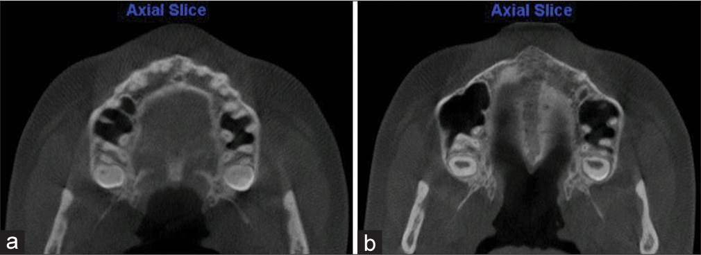 Axial view showing suture opening before and after expansion. (a) Pre-expansion. (b) Postexpansion